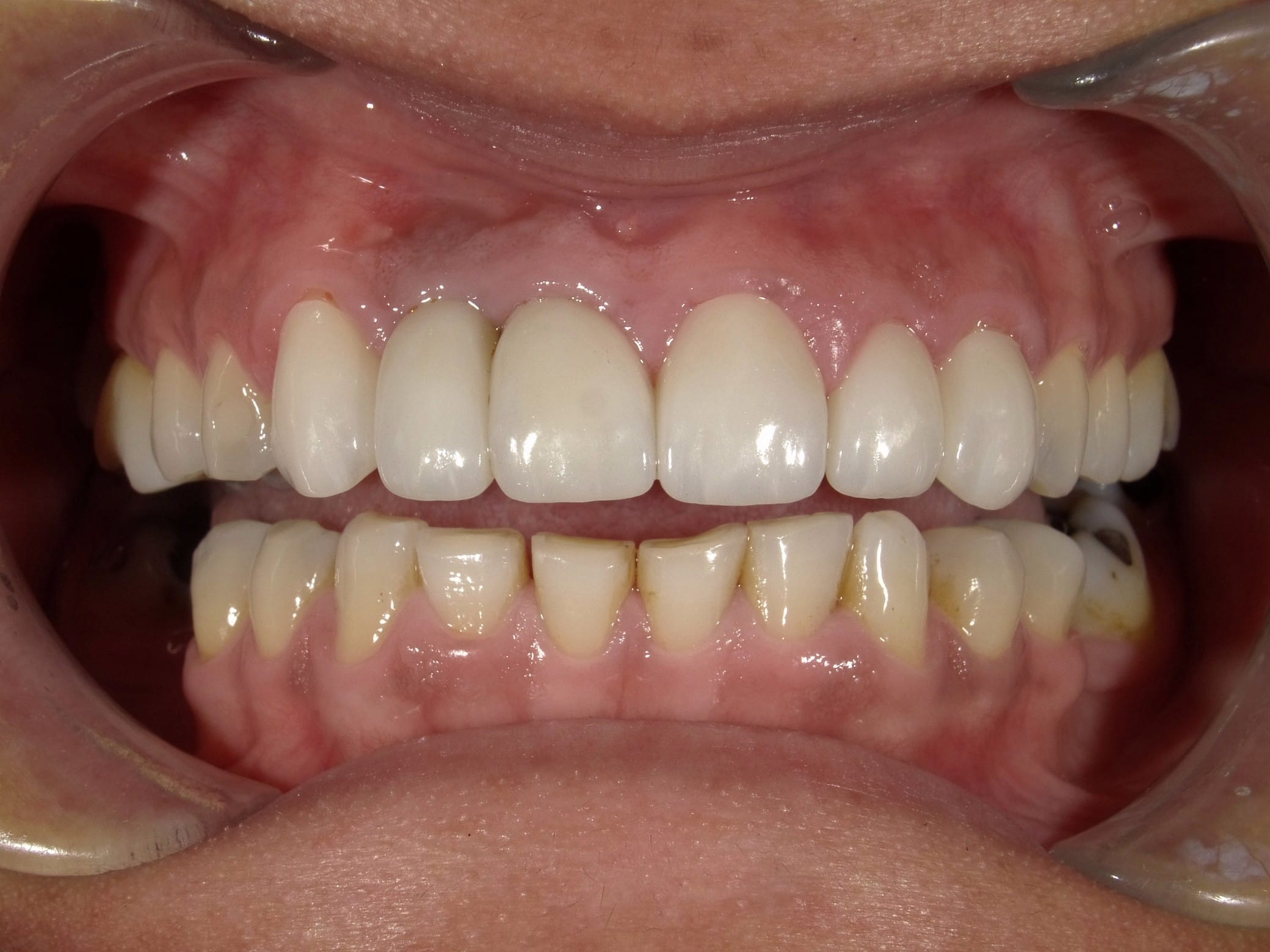 A little less gross after picture of teeth