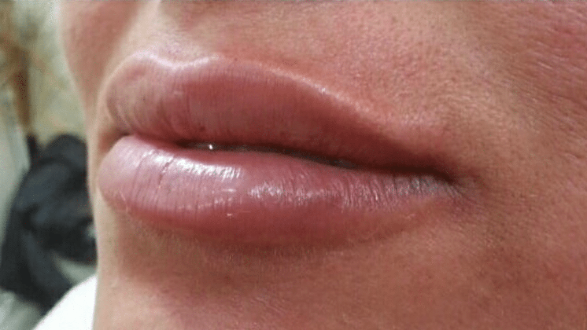 After Photo of Botox Lip Filler at Verber Advanced Dental Studio in Enola, PA 3