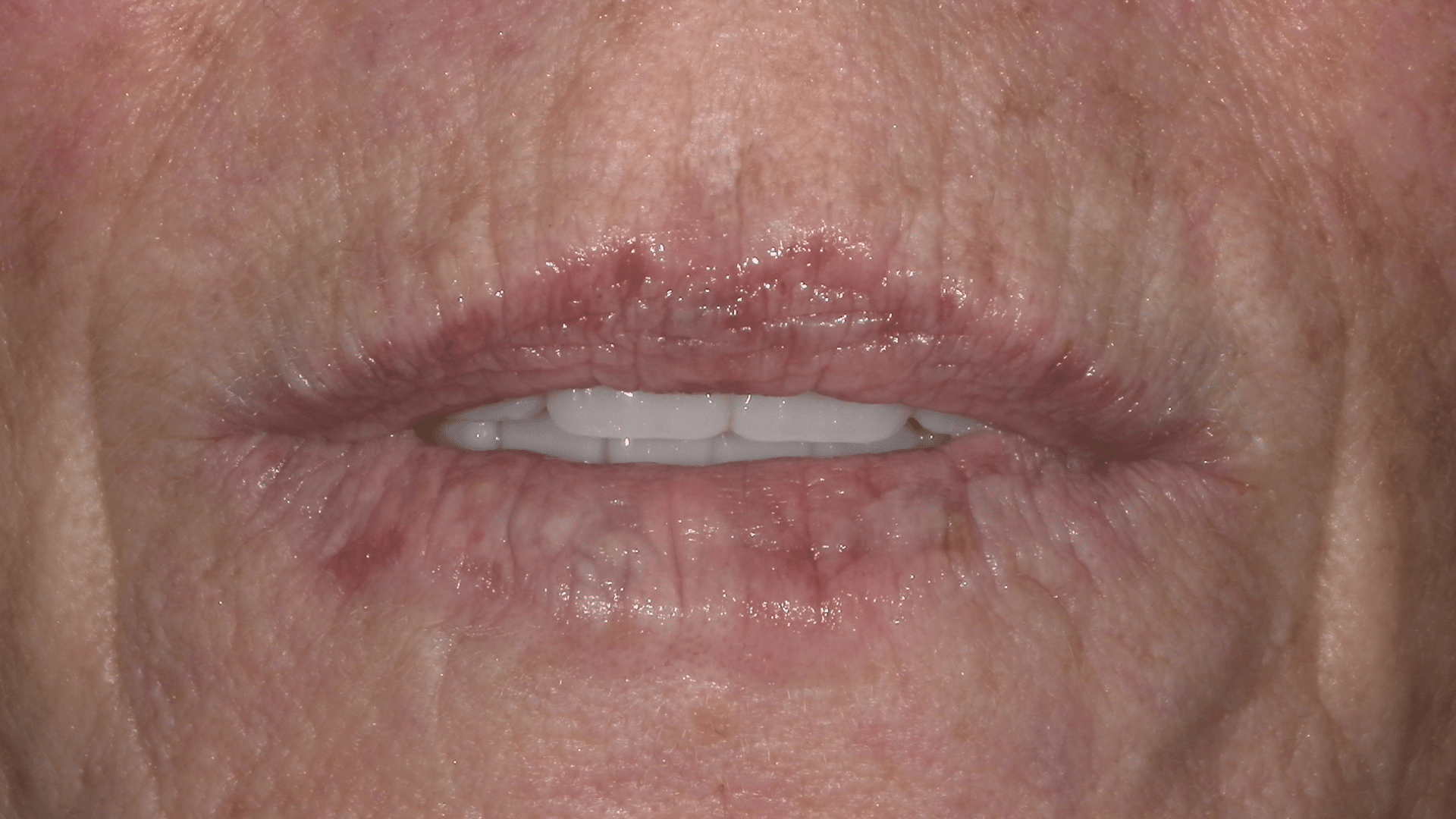 Before Photo of Botox Lip Filler at Verber Advanced Dental Studio in Enola, PA