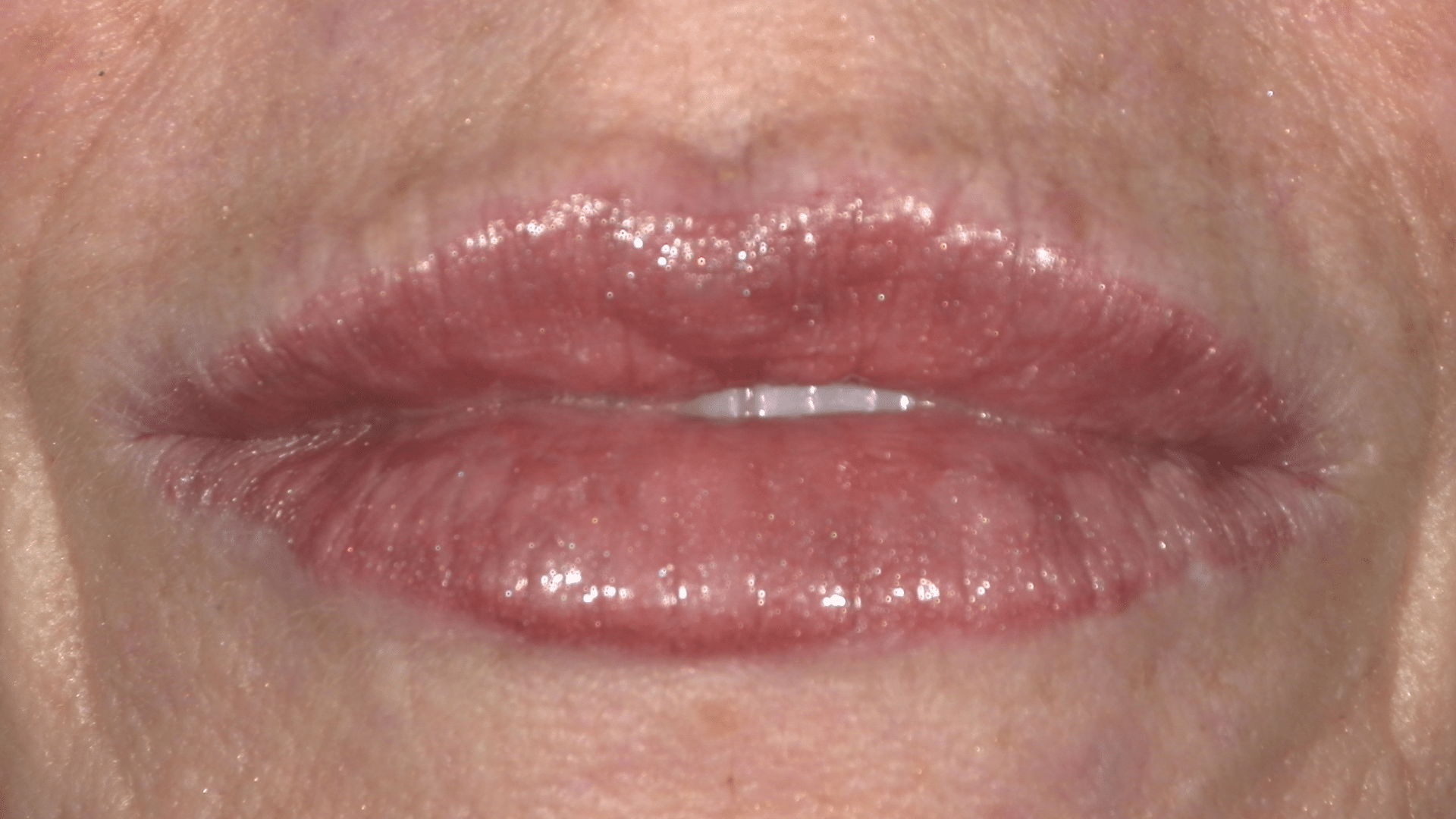 After Photo of Botox Lip Filler at Verber Advanced Dental Studio in Enola, PA